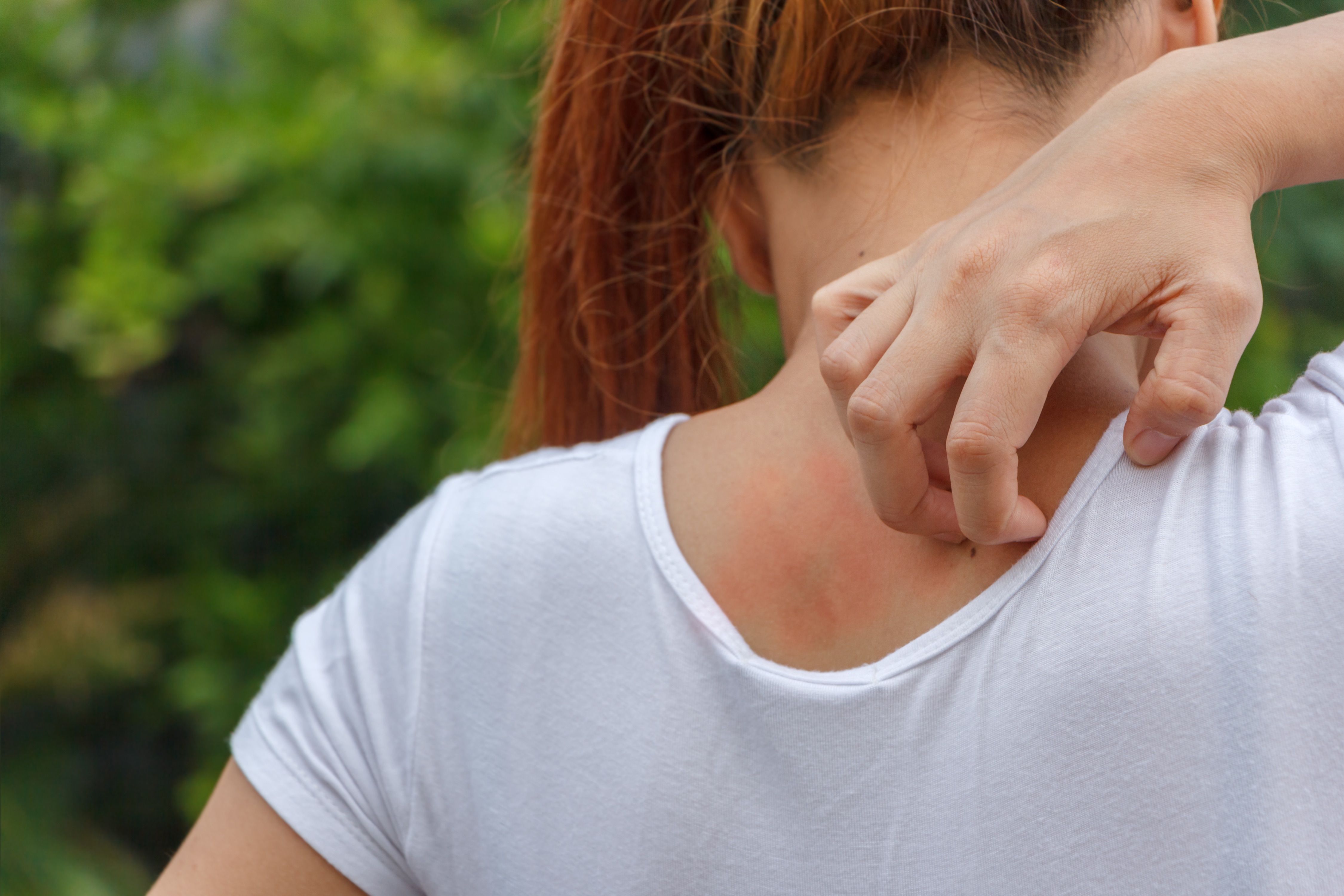 Atopic dermatitis 